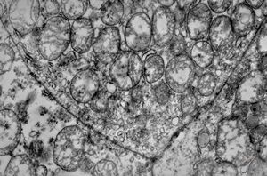 M,12y. | multiple mitochondria in oncocyte - Ewing sarcoma